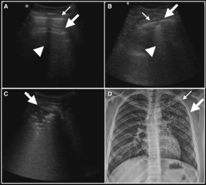 Consolidation lung